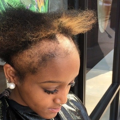 Traction Alopecia